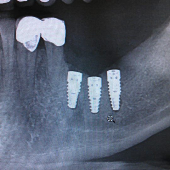 Postavljanje implantata 1