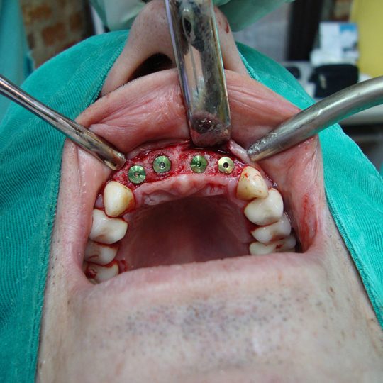 Postavljanje implantata 2