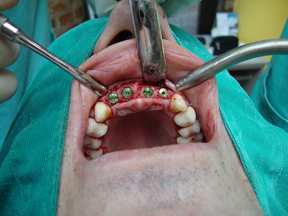 Postavljanje-implantata-28.jpg