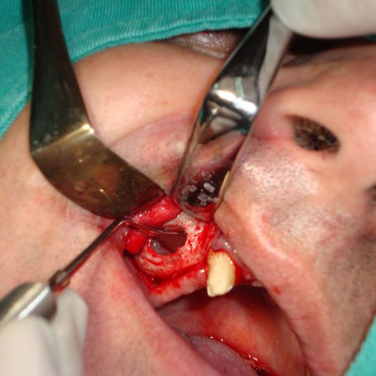 Sinus lift