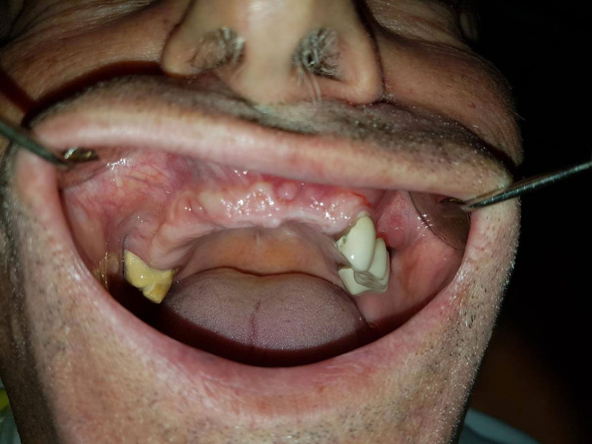 ugradnja-zubnih-implantata-06-1200x900.jpg