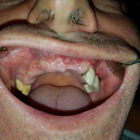 Ugradnja zubnih implantata
